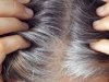 White hair tension! here is good homemade remedies