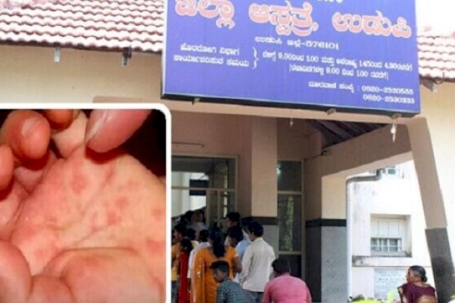 Tomato fever scare starts in India: 26 children detected in this state