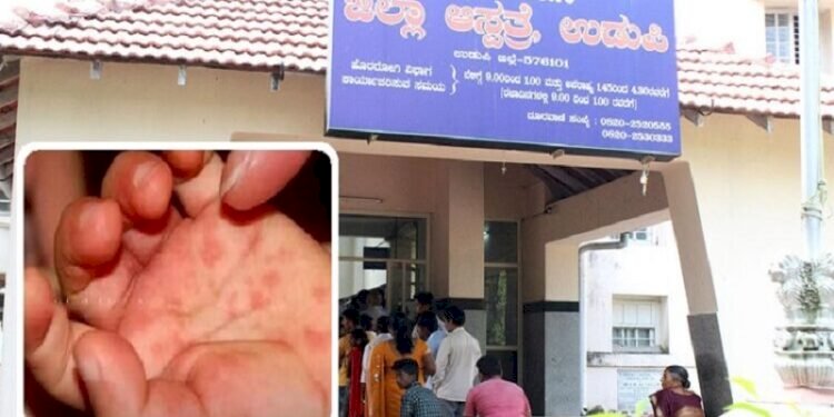 Tomato fever in Udupi for a 4-year-old baby: health department clarification