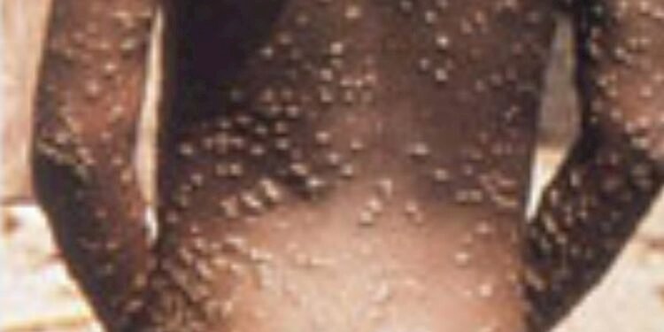 Monkeypox Rapidly Spreading: Union Ministry directed officers to be vigilant